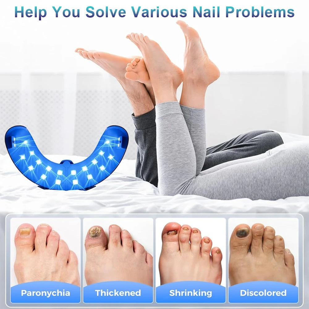 Nail Fungus Laser Device for Multiple Toenail 905nm470nm 7Minutes Painless Removes Ingrown Toenail Calcium Nail Fungus Treatment