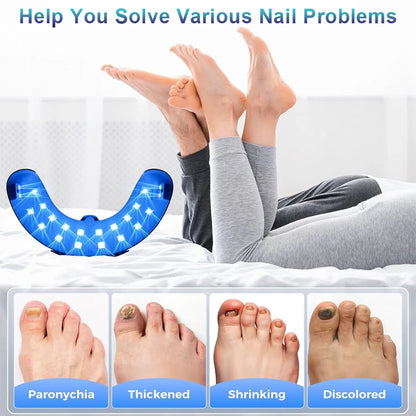 Nail Fungus Laser Device for Multiple Toenail 905nm470nm 7Minutes Painless Removes Ingrown Toenail Calcium Nail Fungus Treatment